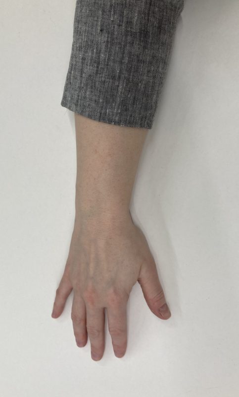 02 - Measure Needed Cuff Length